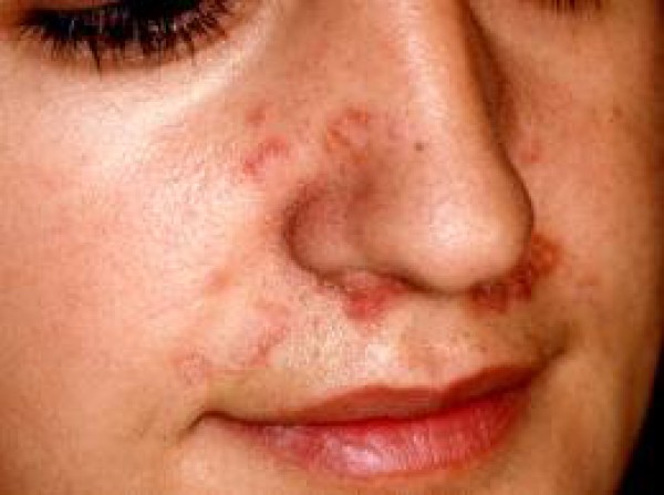 La psoriasis el tratamiento la presentación